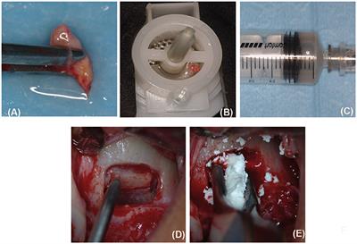 Autologous Periosteum-Derived Micrografts and PLGA/HA Enhance the Bone Formation in Sinus Lift Augmentation